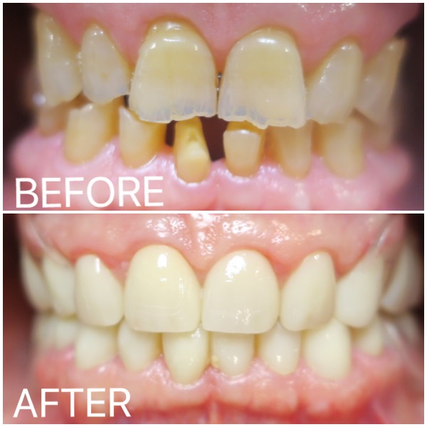 Montevallo AL Dentist for Dental Crowns